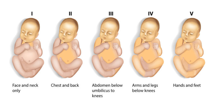 Jaundice in Newborn Babies - Neobliss Newborn Care